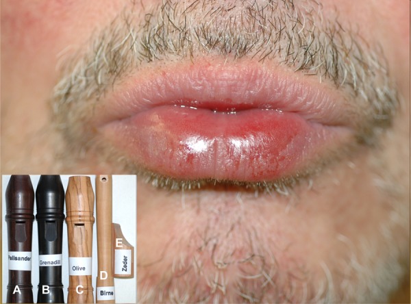 Contact dermatitis of the lips due to late-type sensitization against dalbergiones in a wooden recorder.