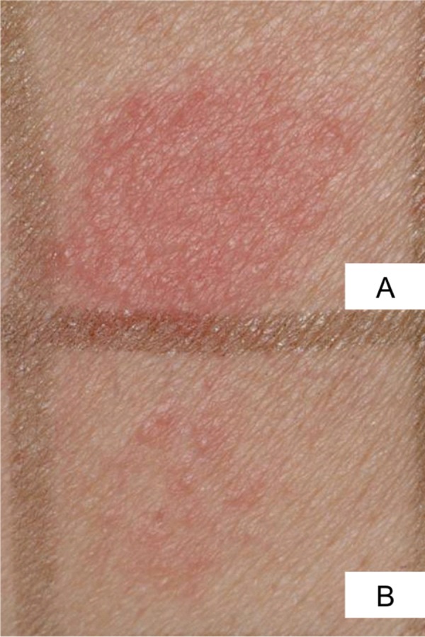 Contact dermatitis of the lips due to late-type sensitization against dalbergiones in a wooden recorder.