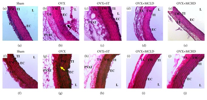 Vascular Protective Effects of <i>Morinda citrifolia</i> Leaf Extract on Postmenopausal Rats Fed with Thermoxidized Palm Oil Diet: Evidence at Microscopic Level.