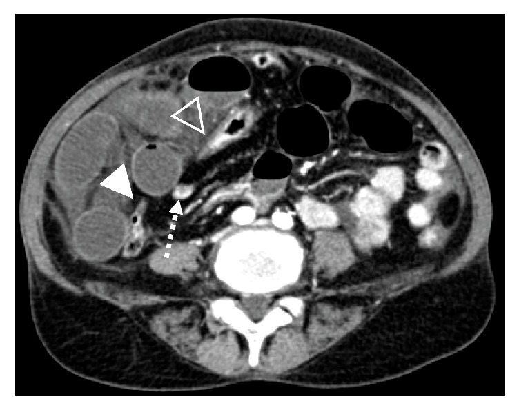 Closed Loop Obstruction from Epiploic Appendage Adhesion Mimicking Pericecal Internal Hernia.