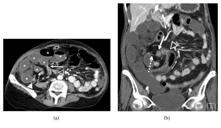 Closed Loop Obstruction from Epiploic Appendage Adhesion Mimicking Pericecal Internal Hernia.