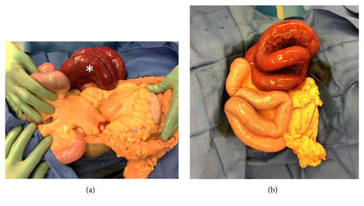 Closed Loop Obstruction from Epiploic Appendage Adhesion Mimicking Pericecal Internal Hernia.