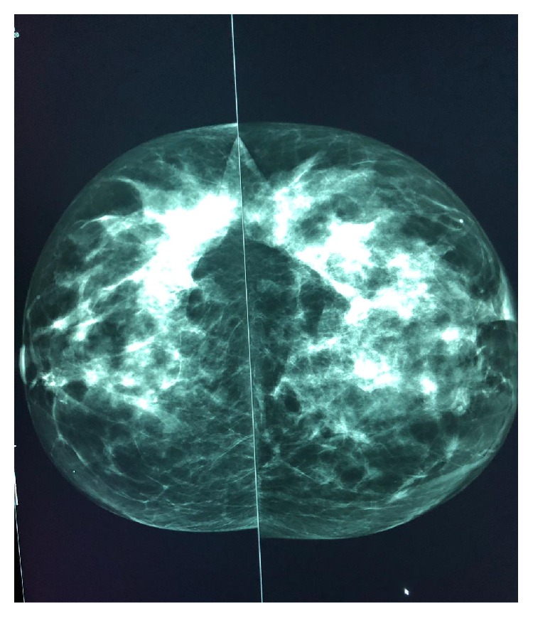 Multiple Myeloma Breast Involvement: A Case Report.