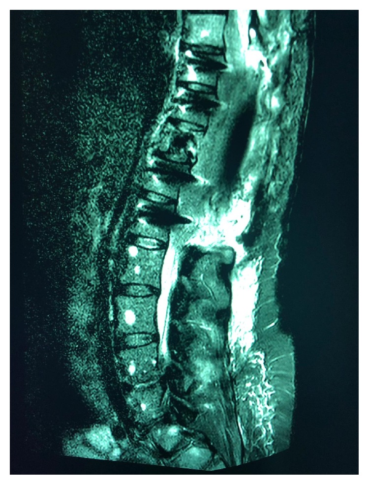 Multiple Myeloma Breast Involvement: A Case Report.