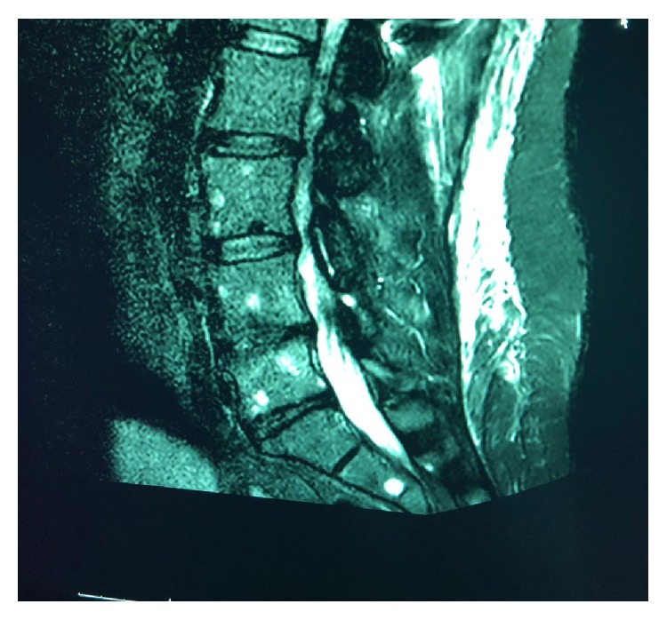 Multiple Myeloma Breast Involvement: A Case Report.