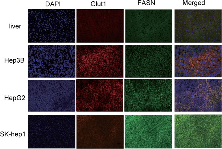 PET Imaging of Hepatocellular Carcinomas: <sup>18</sup>F-Fluoropropionic Acid as a Complementary Radiotracer for <sup>18</sup>F-Fluorodeoxyglucose.