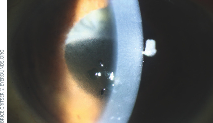 Cataract surgery in patients with Fuchs' endothelial corneal dystrophy.