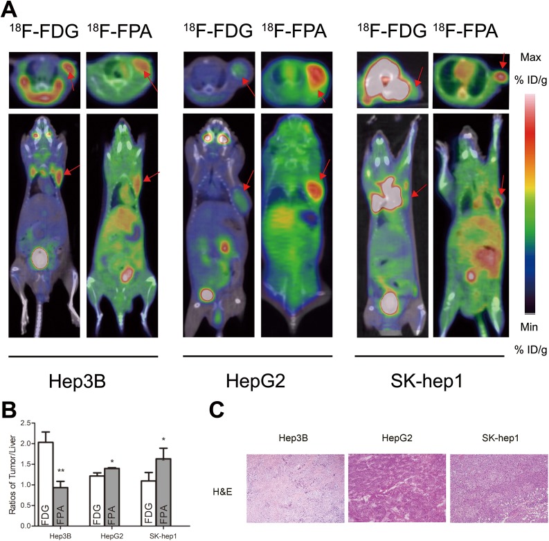 PET Imaging of Hepatocellular Carcinomas: <sup>18</sup>F-Fluoropropionic Acid as a Complementary Radiotracer for <sup>18</sup>F-Fluorodeoxyglucose.