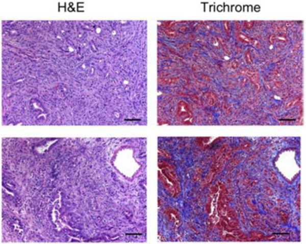 The Evolving Field of Stereotactic Body Radiation Therapy in Pancreatic Cancer.