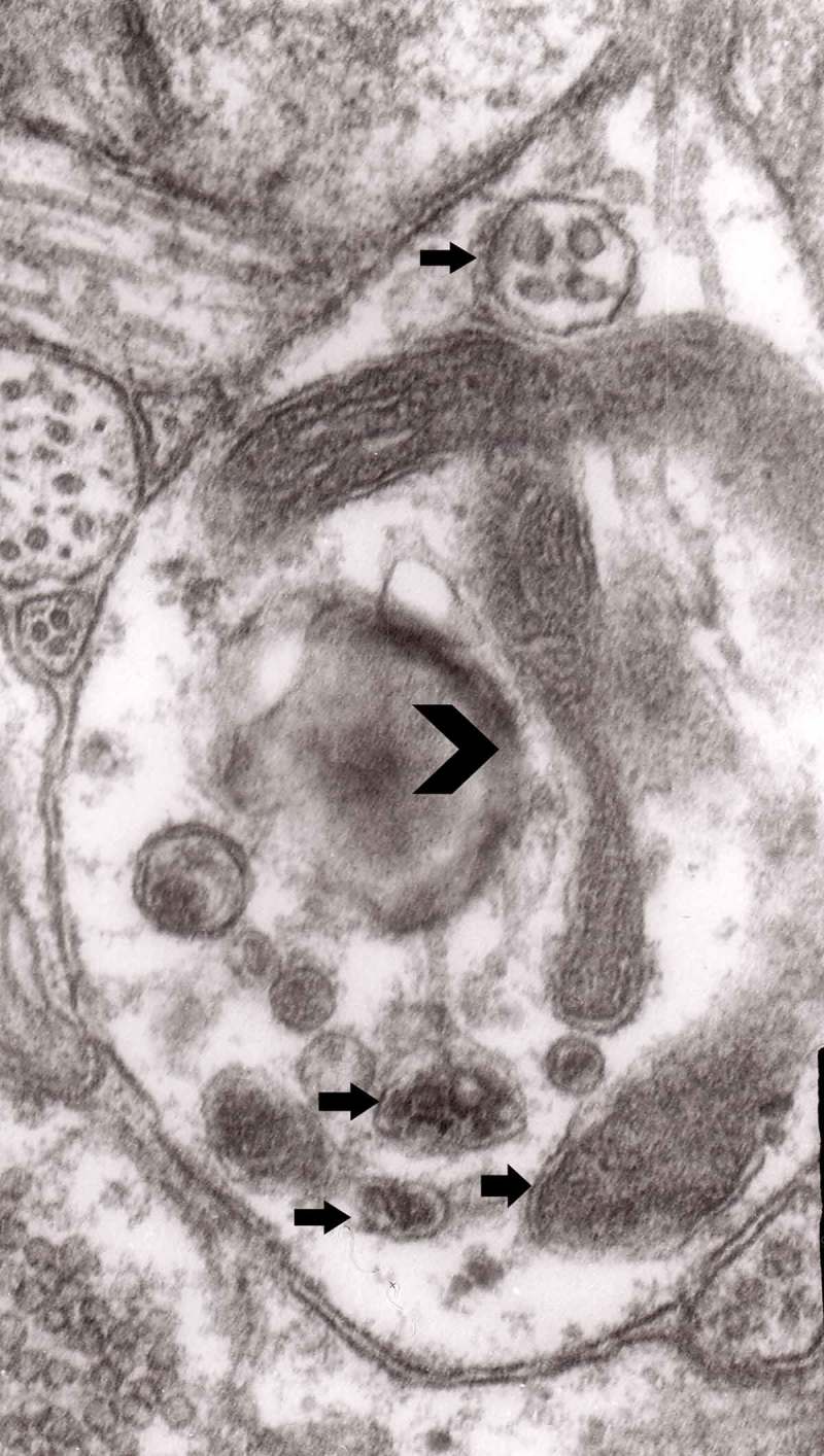 Axonal changes in experimental prion diseases recapitulate those following constriction of postganglionic branches of the superior cervical ganglion: a comparison 40 years later.