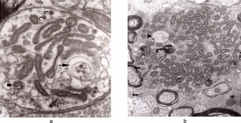 Axonal changes in experimental prion diseases recapitulate those following constriction of postganglionic branches of the superior cervical ganglion: a comparison 40 years later.