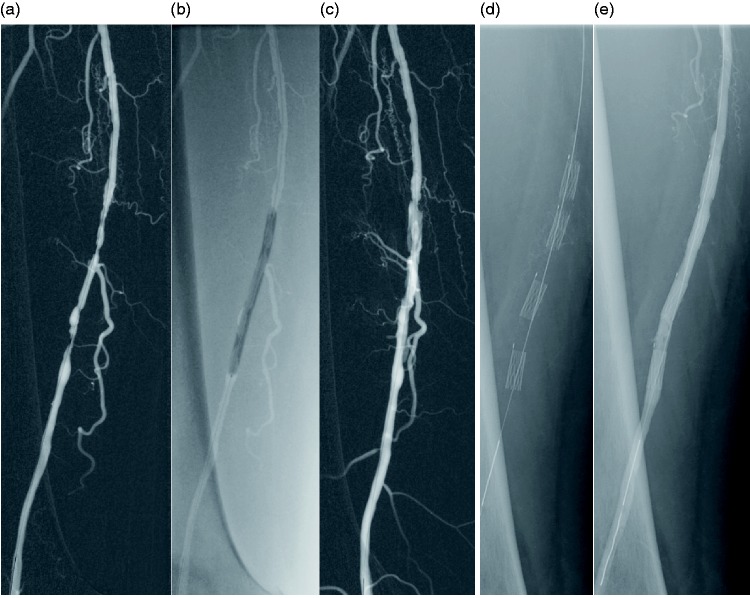 Multiple Stent Delivery System "Multi-LOC": Focal self-expanding nitinol stenting of complex femoropopliteal lesions-A monocenter feasibility pilot study.