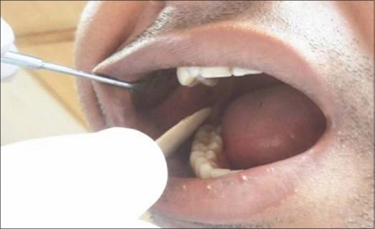 Micronuclei in Exfoliated Cells: A Biomarker of Genotoxicity in Tobacco Users.