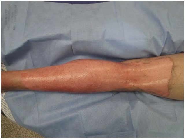 Successful treatment of mixed depth flame burns using enzymatic debridement with Nexobrid™ in a patient with aggressive systemic sclerosis (scleroderma).