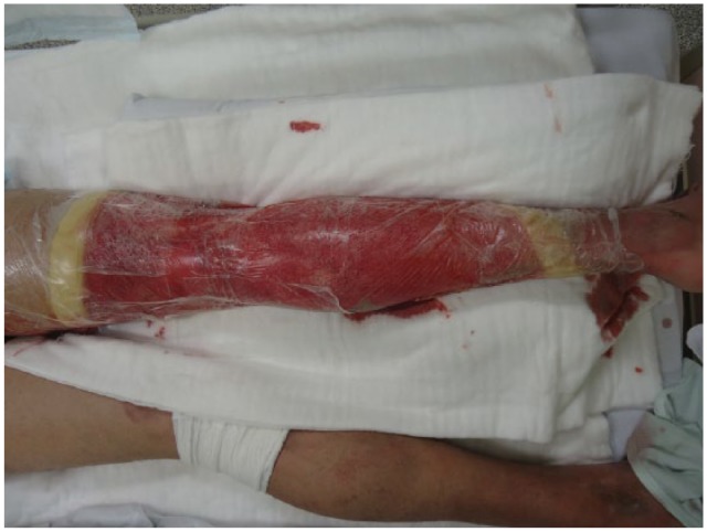 Successful treatment of mixed depth flame burns using enzymatic debridement with Nexobrid™ in a patient with aggressive systemic sclerosis (scleroderma).