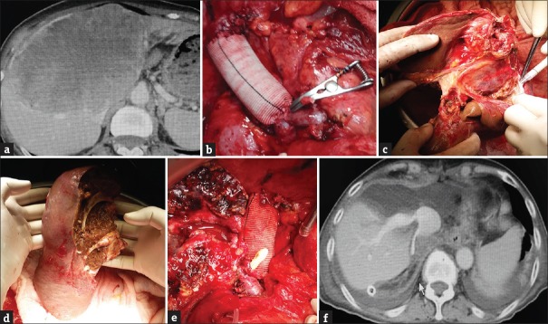 <i>Ex situ</i> Liver Resection and Partial Liver Autotransplantation for Advanced Cholangiocarcinoma.