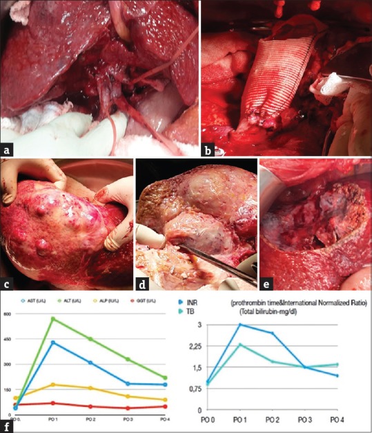 <i>Ex situ</i> Liver Resection and Partial Liver Autotransplantation for Advanced Cholangiocarcinoma.