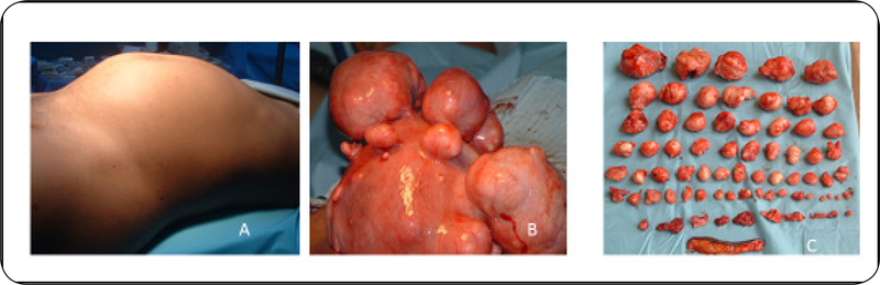 Burden of Uterine Fibroids: An African Perspective, A Call for Action and Opportunity for Intervention.