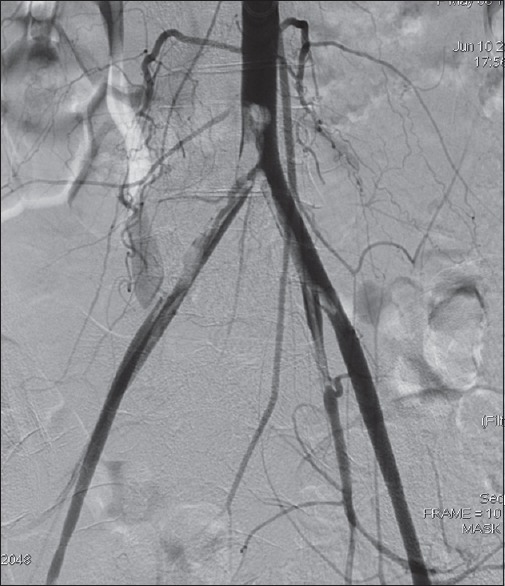 Limb Revascularization of Peripheral Artery Disease in the Developing Countries: Earliest 1-Year Experience from Northwestern Nigeria.