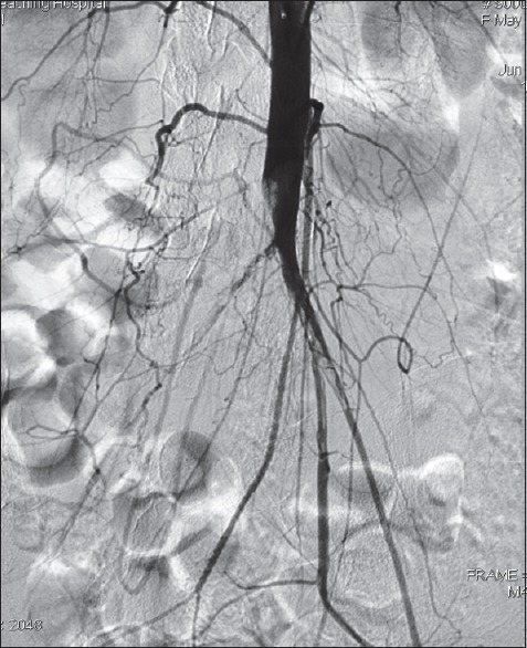 Limb Revascularization of Peripheral Artery Disease in the Developing Countries: Earliest 1-Year Experience from Northwestern Nigeria.