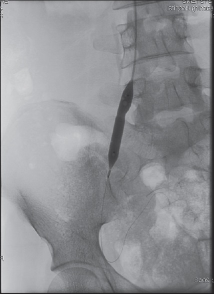 Limb Revascularization of Peripheral Artery Disease in the Developing Countries: Earliest 1-Year Experience from Northwestern Nigeria.