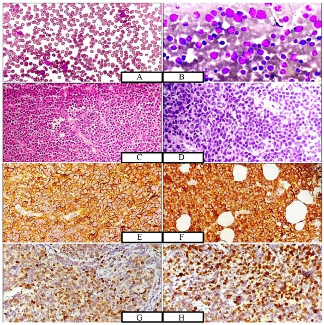 Diffuse Large B-Cell Lymphoma Relapsing in Leukaemic Phase Presenting as Acute Leukaemia.