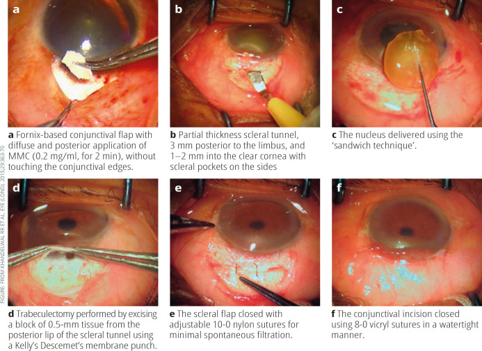 Managing cataract surgery in patients with glaucoma.