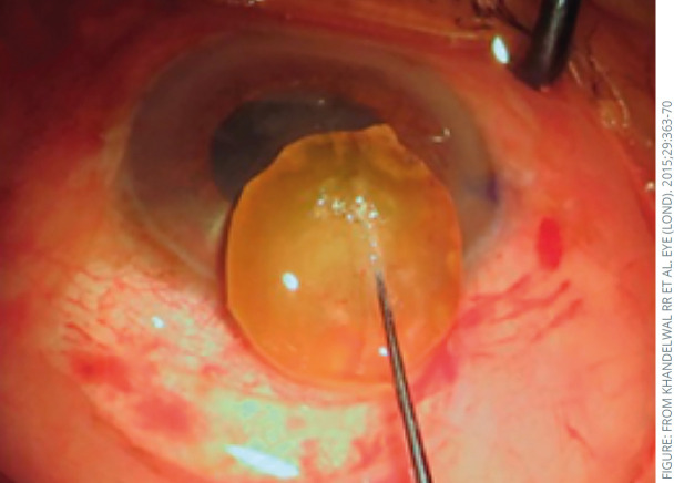 Managing cataract surgery in patients with glaucoma.