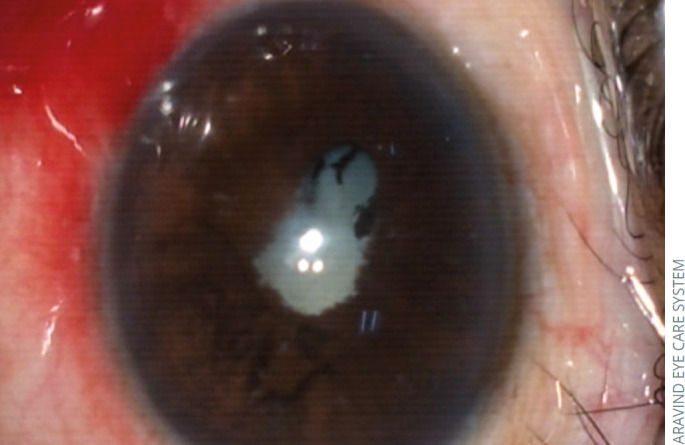 Managing cataract surgery in patients with uveitis.