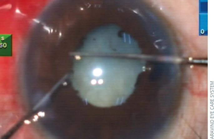 Managing cataract surgery in patients with uveitis.