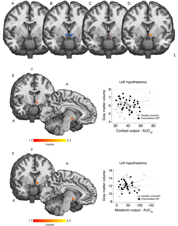 Investigating the relationships between hypothalamic volume and measures of circadian rhythm and habitual sleep in premanifest Huntington's disease