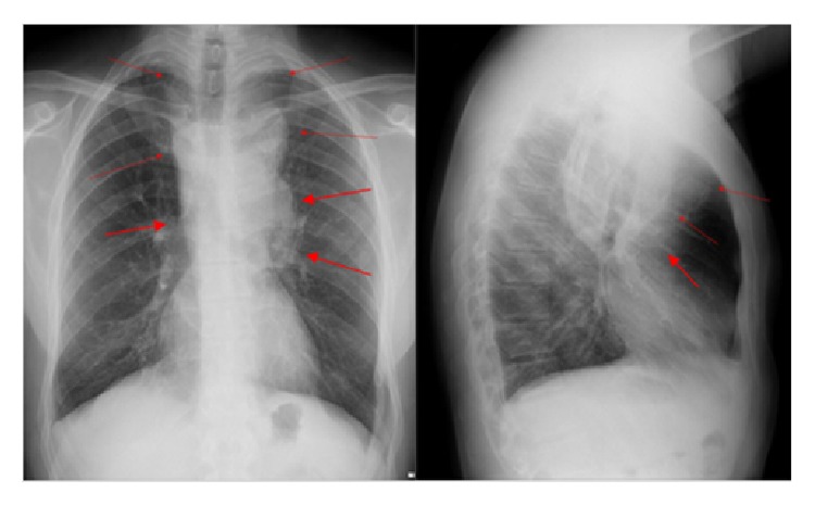 The Diagnostic Challenge of an Infrequent Spectrum of <i>Cryptococcus</i> Infection.