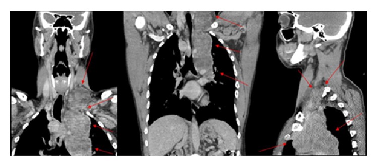 The Diagnostic Challenge of an Infrequent Spectrum of <i>Cryptococcus</i> Infection.