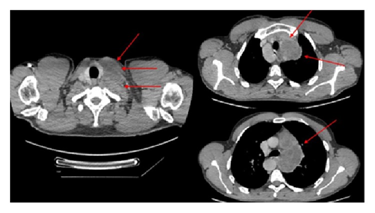 The Diagnostic Challenge of an Infrequent Spectrum of <i>Cryptococcus</i> Infection.