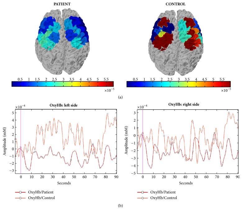 Motor Cortex Function in Fibromyalgia: A Study by Functional Near-Infrared Spectroscopy.