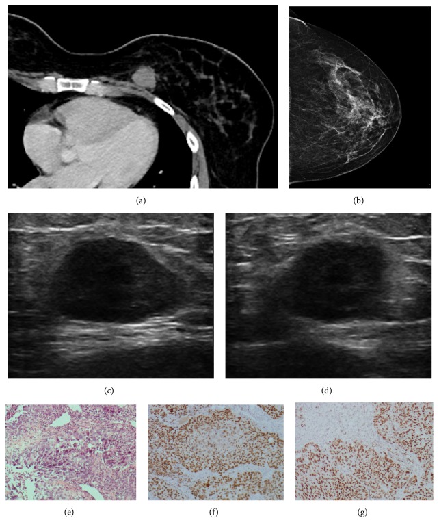 A Case Series of Breast Metastases from Different Extramammary Malignancies and Their Literature Review.