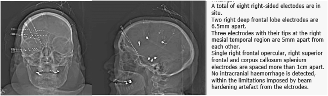 Ability to knit may be impaired following right temporal lobe resection for drug-resistant epilepsy