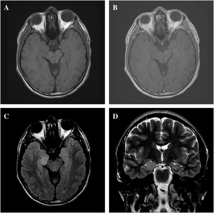 Mesial temporal extraventricular neurocytoma (mtEVN): A case report and literature review