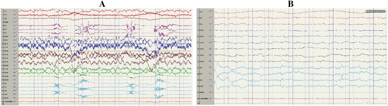 Mesial temporal extraventricular neurocytoma (mtEVN): A case report and literature review