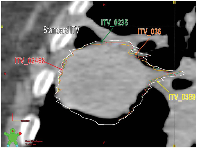 Dosimetric Implications of Number of Breathing Phases Used in the Definition of Internal Target Volume [ITV] in the Treatment of Non-Small Cell Lung Cancers Using Stereotactic Body Radiation Therapy (SBRT).