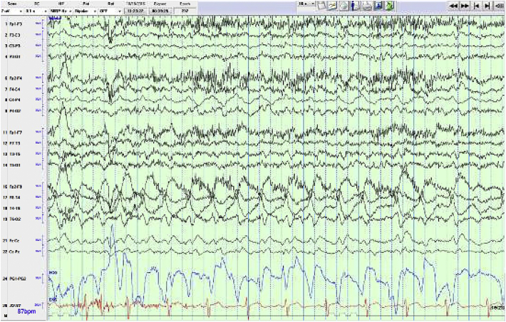 Mesial temporal extraventricular neurocytoma (mtEVN): A case report and literature review