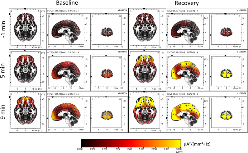 Brain dynamics during the sleep onset transition: An EEG source localization study