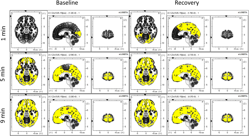 Brain dynamics during the sleep onset transition: An EEG source localization study