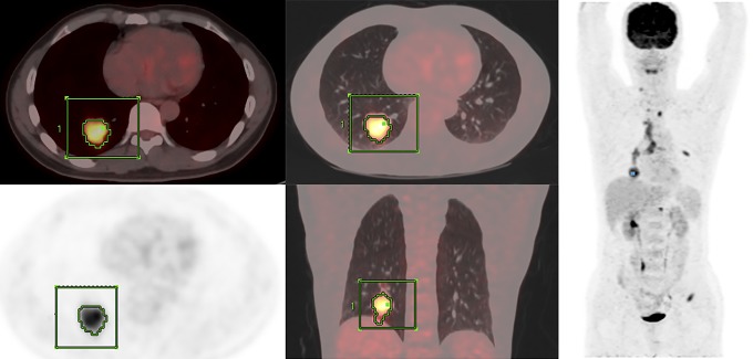 Prognostic and Predictive Values of Metabolic Parameters of <sup>18</sup>F-FDG PET/CT in Patients With Non-Small Cell Lung Cancer Treated With Chemotherapy.