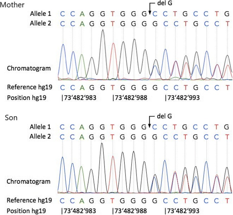 A novel elastin gene frameshift mutation in a Russian family with cutis laxa: a case report.