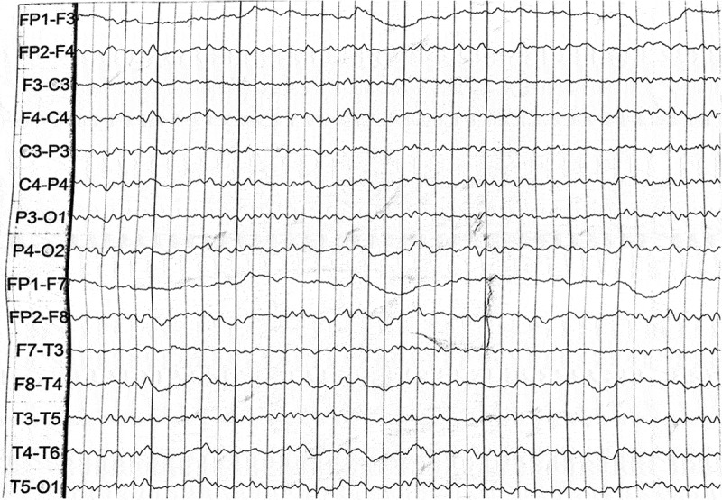 Clinical features and genetic characteristics of two Chinese pedigrees with fatal family insomnia.