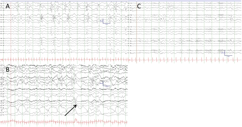 Epileptic spasms as the presenting seizure type in a patient with a new “O” of TORCH, congenital Zika virus infection