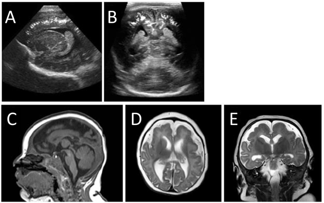 Epileptic spasms as the presenting seizure type in a patient with a new “O” of TORCH, congenital Zika virus infection