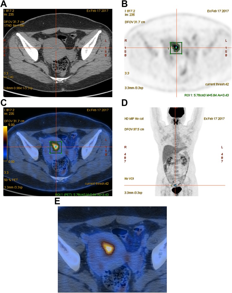 <sup>18</sup>F-FDG PET/CT Quantitative Parameters and Texture Analysis Effectively Differentiate Endometrial Precancerous Lesion and Early-Stage Carcinoma.