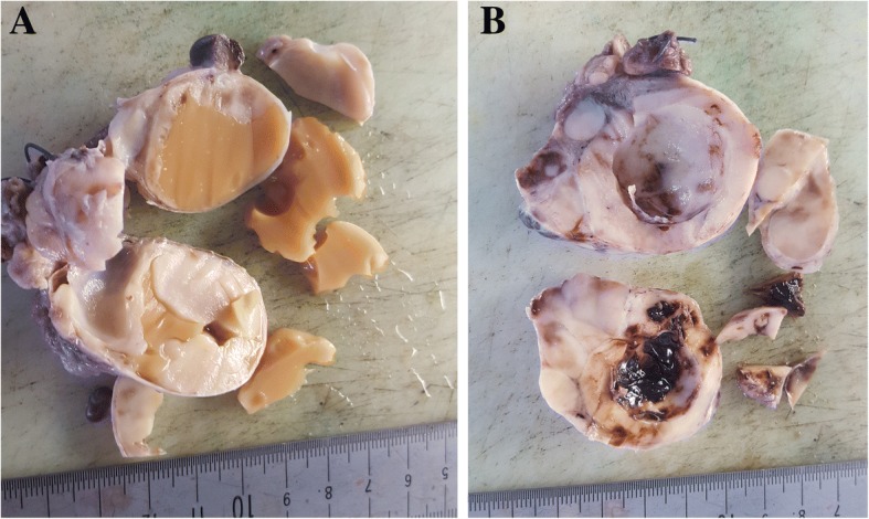 Extra-uterine low grade endometrioid stromal sarcoma arising from ovarian endometriosis: a case report and review of the literature.